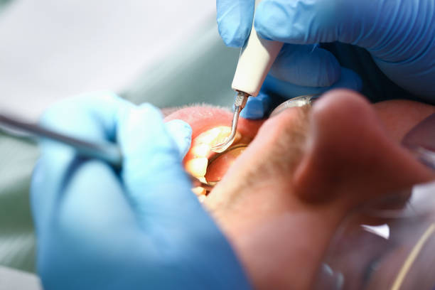 Best Emergency Wisdom Tooth Extraction in Shafter, CA